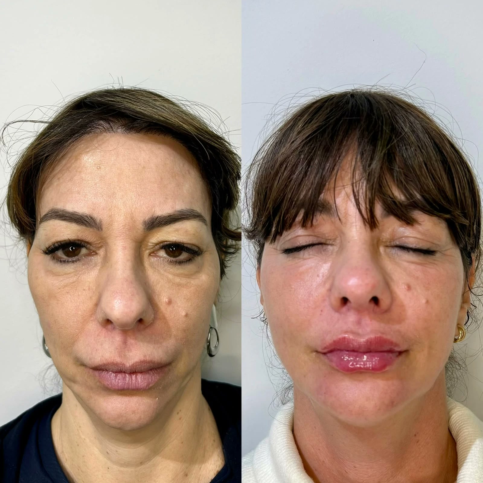 Antes e depois da paciente modelo, de frente