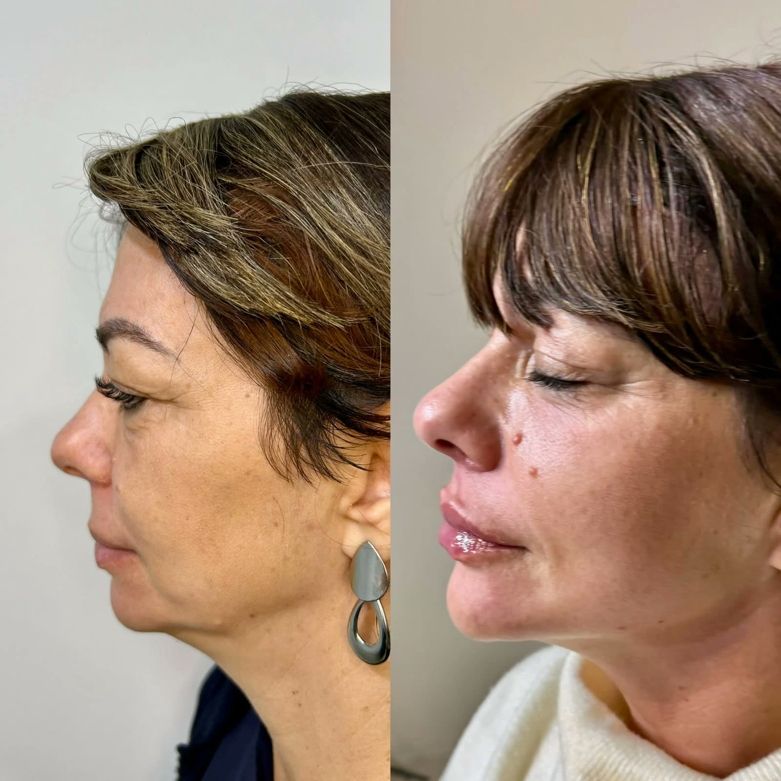 Antes e depois da paciente modelo, de perfil